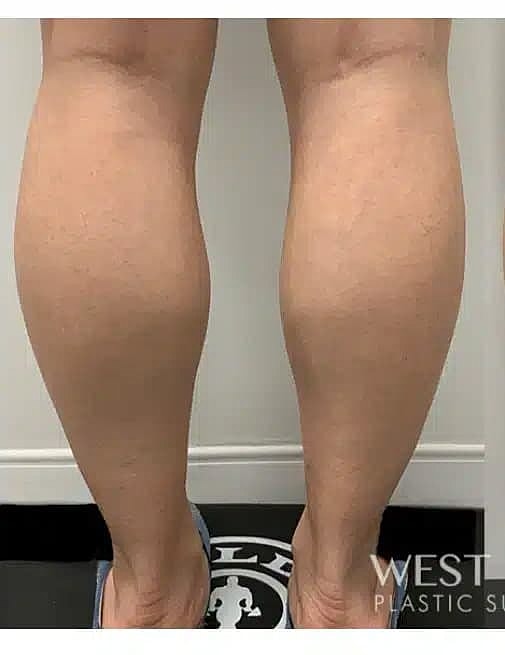 Botox Before & After