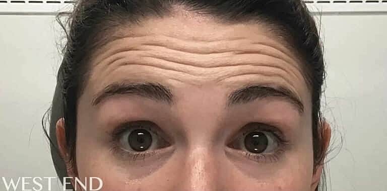Botox Before & After