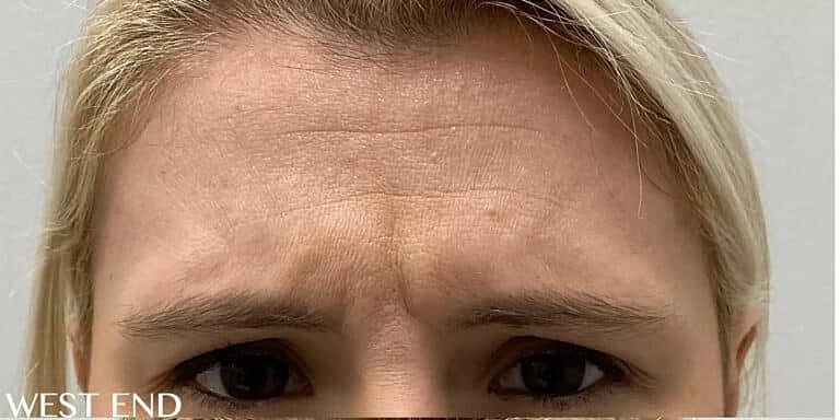 Botox Before & After