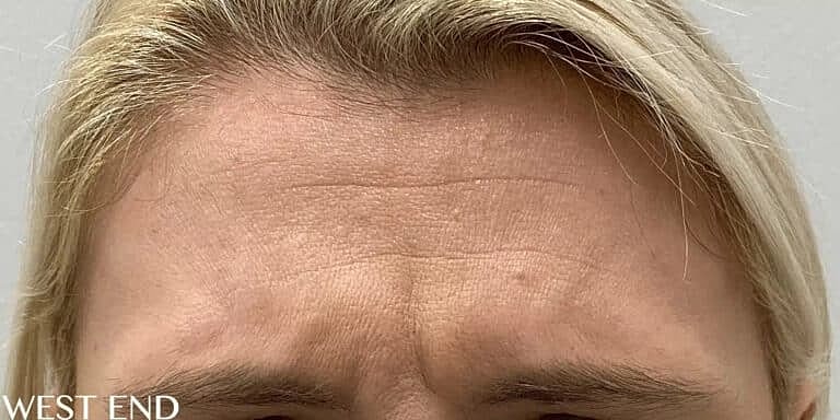 Botox Before & After