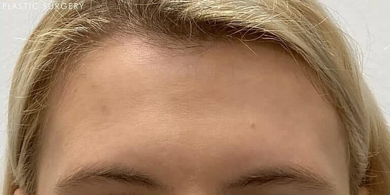 Botox Before & After