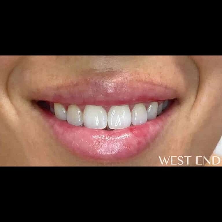 Botox Before & After