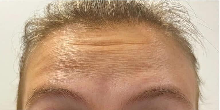 Botox Before & After