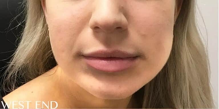 Botox Before & After