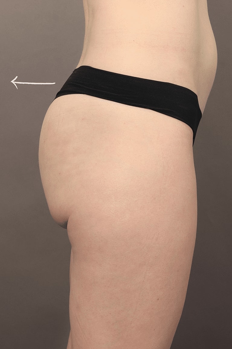 Radiesse Before & After