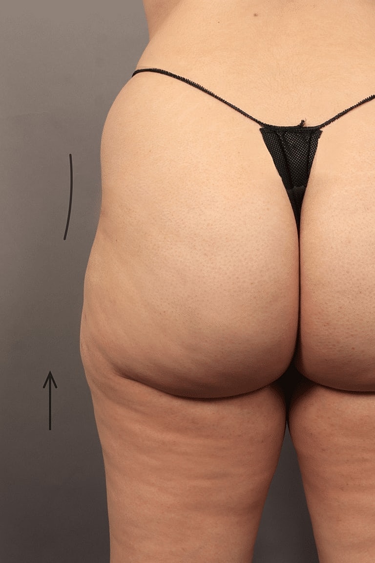 Radiesse Before & After