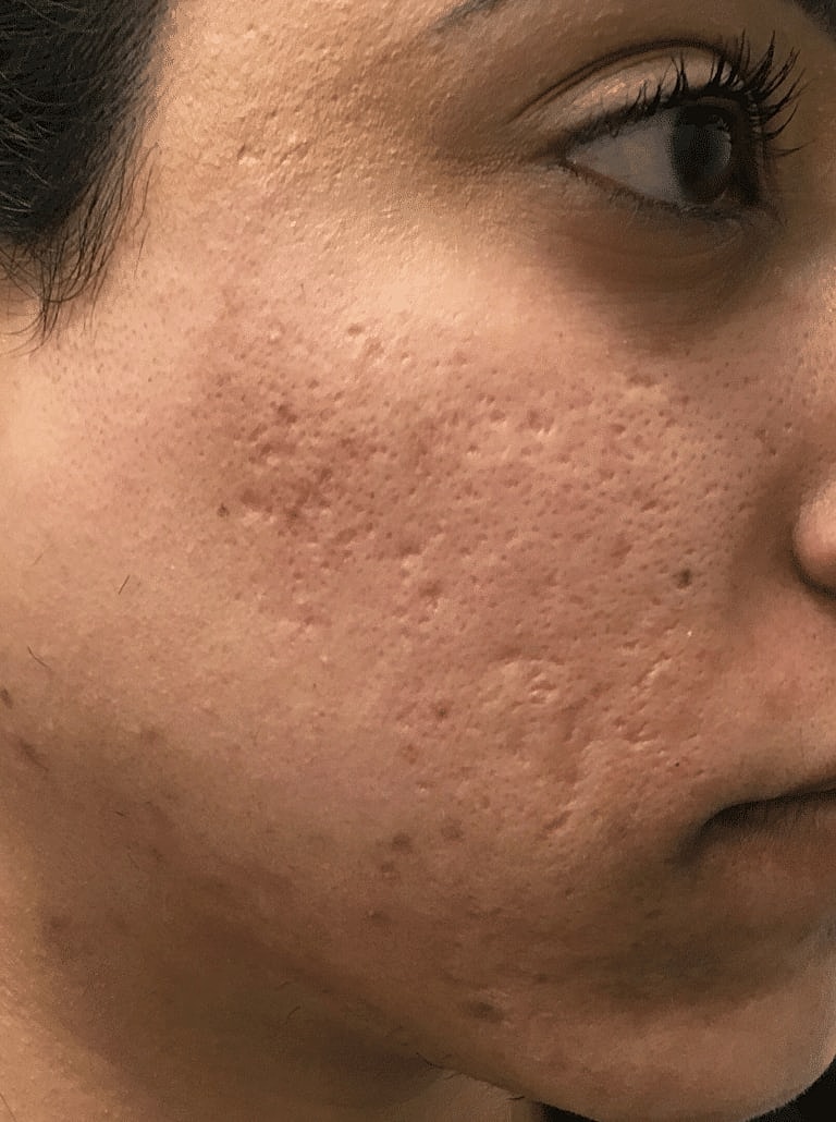 Microneedling Before & After