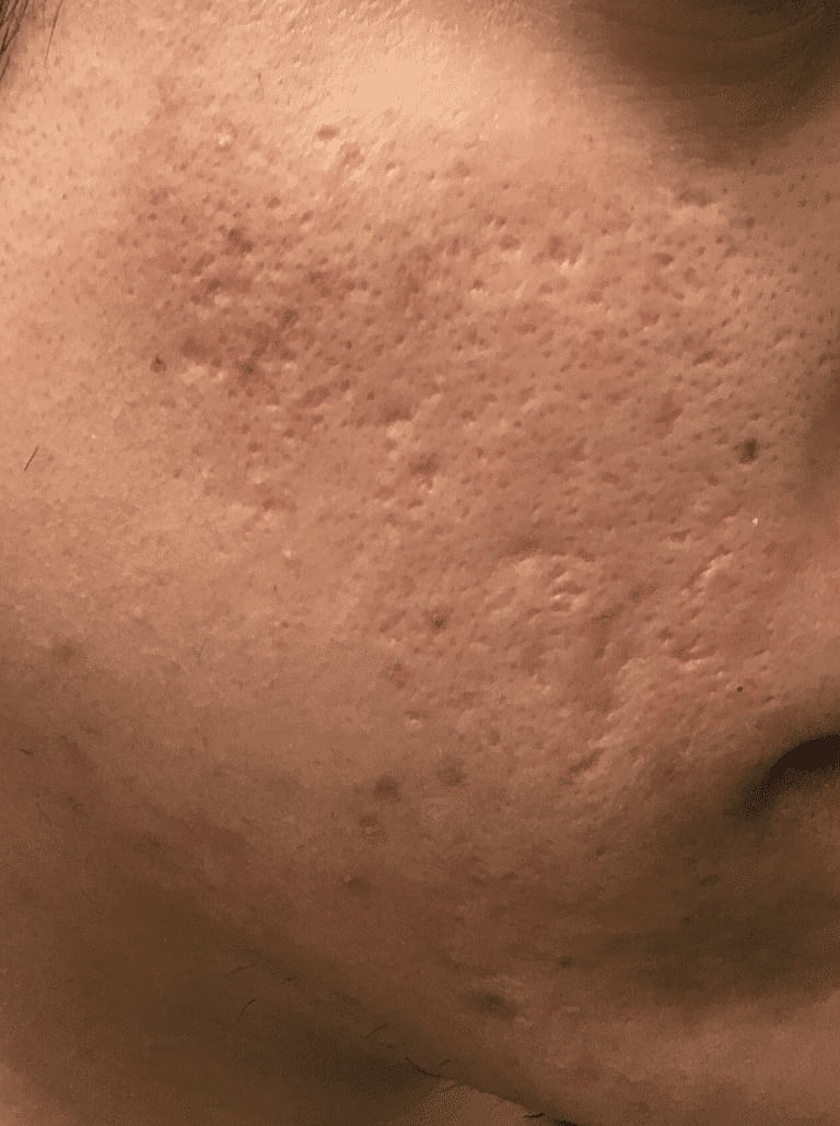 Microneedling Before & After