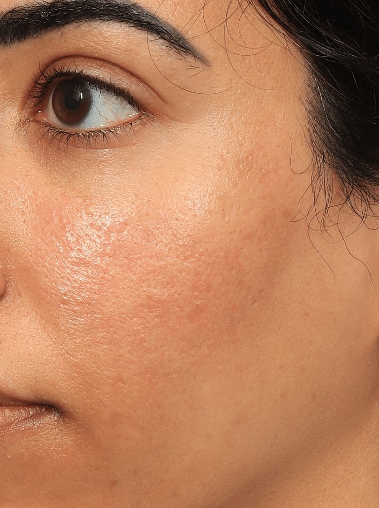 Microneedling Before & After