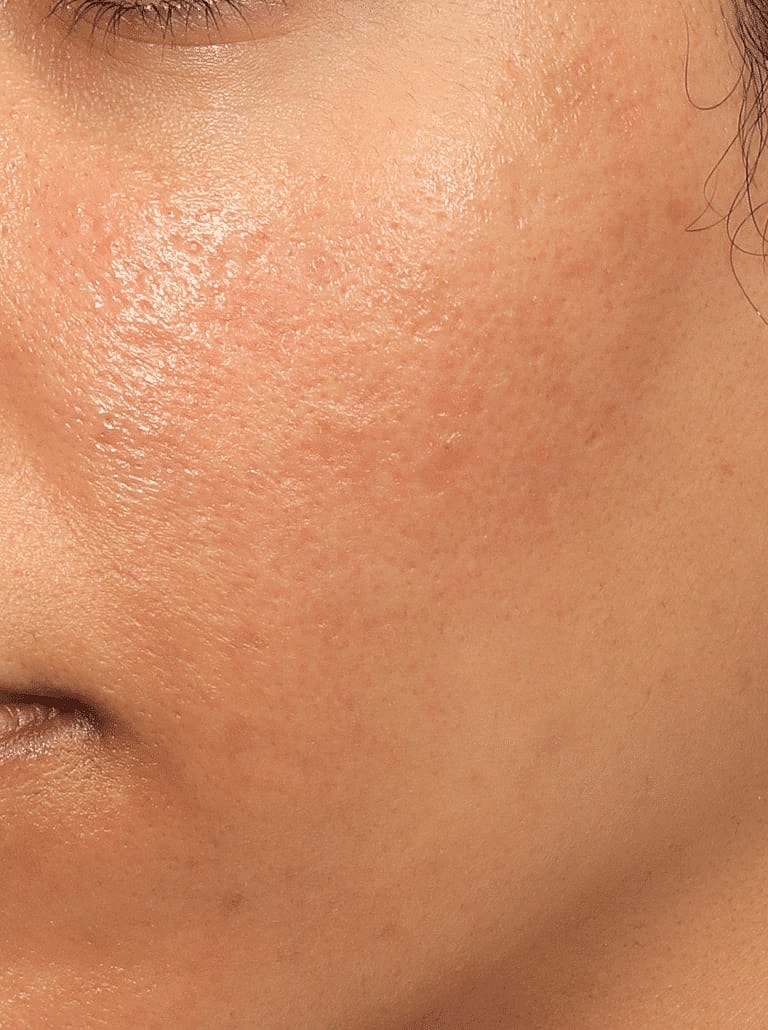 Microneedling Before & After