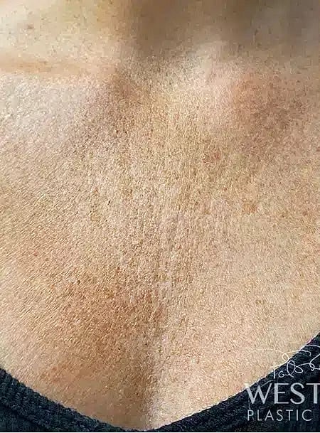 Microneedling Before & After