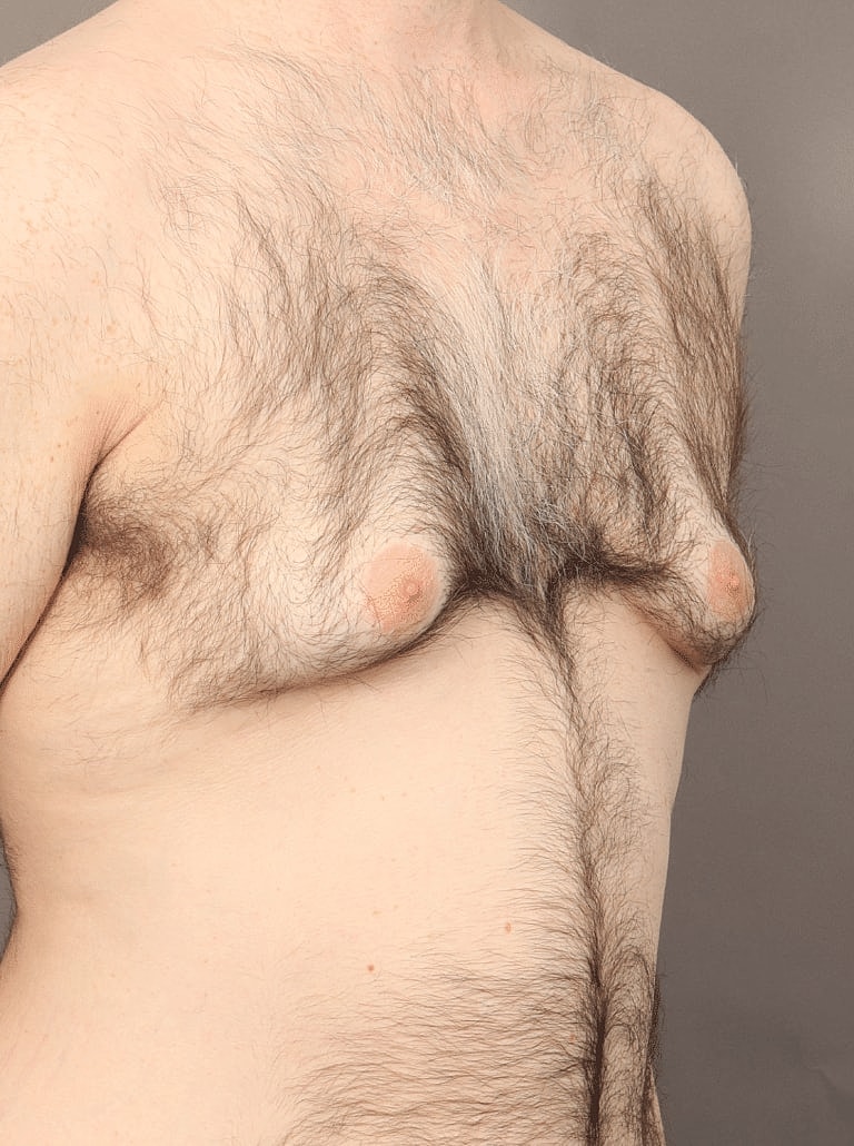 Gynecomastia Before & After