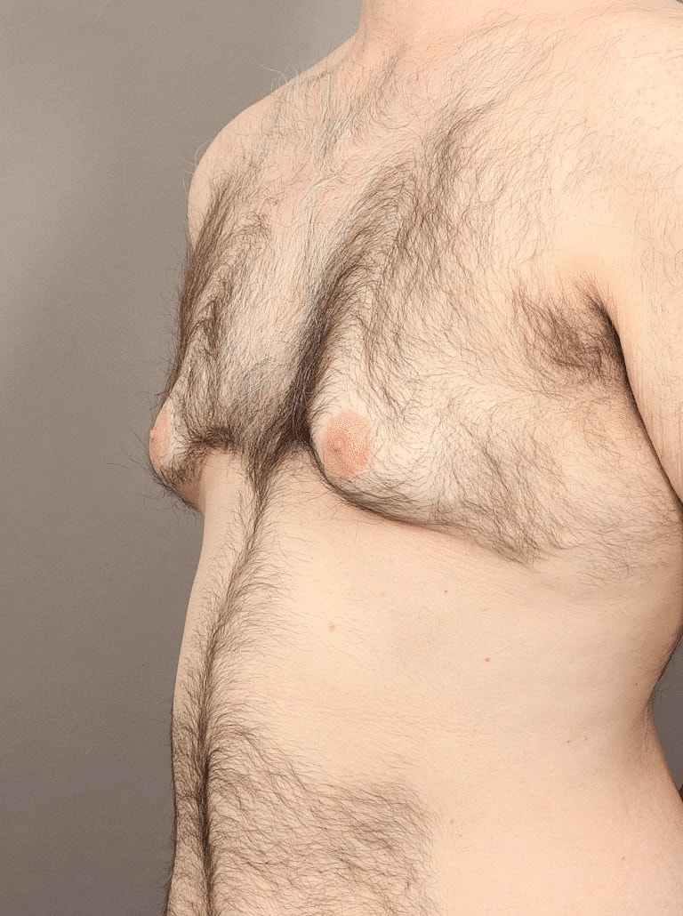 Gynecomastia Before & After