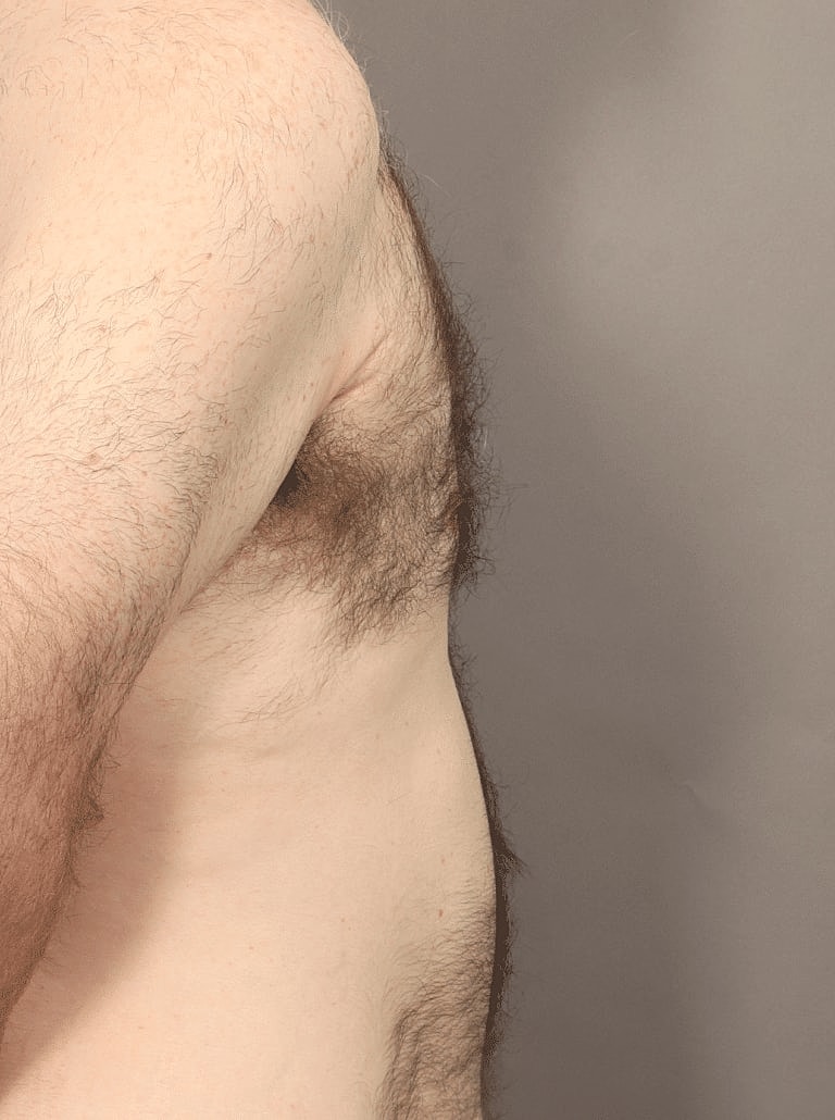 Gynecomastia Before & After