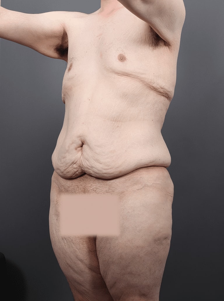 Gynecomastia Before & After