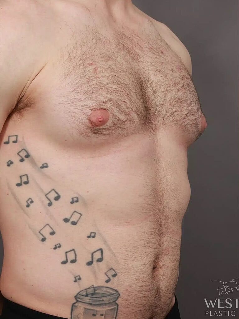 Gynecomastia Before & After