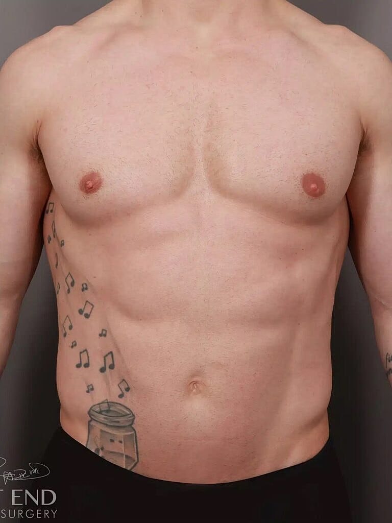 Gynecomastia Before & After