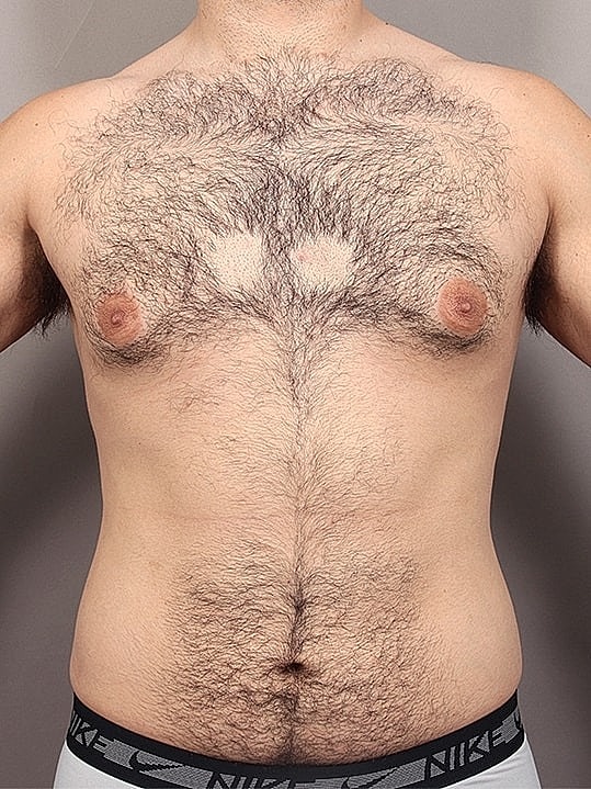 Gynecomastia Before & After
