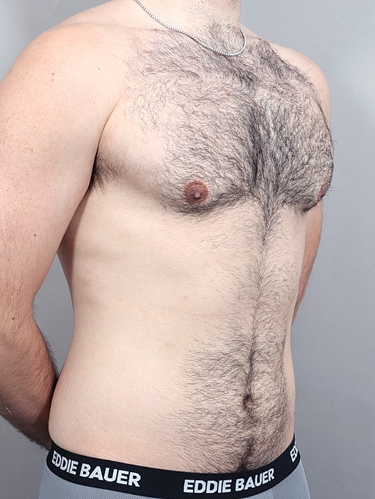 Gynecomastia Before & After