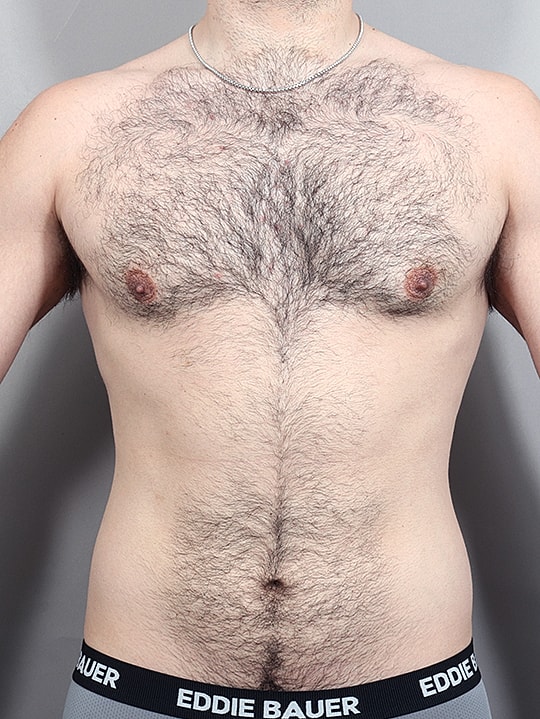 Gynecomastia Before & After