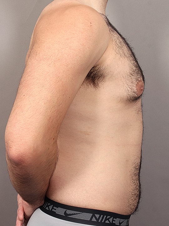 Gynecomastia Before & After