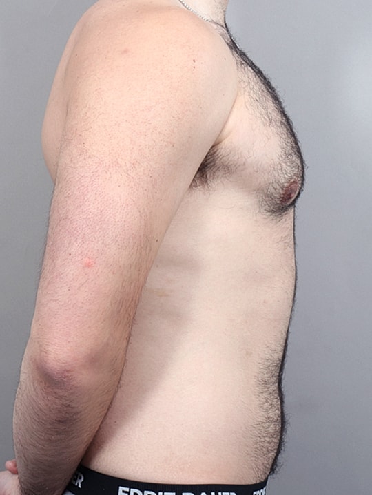 Gynecomastia Before & After