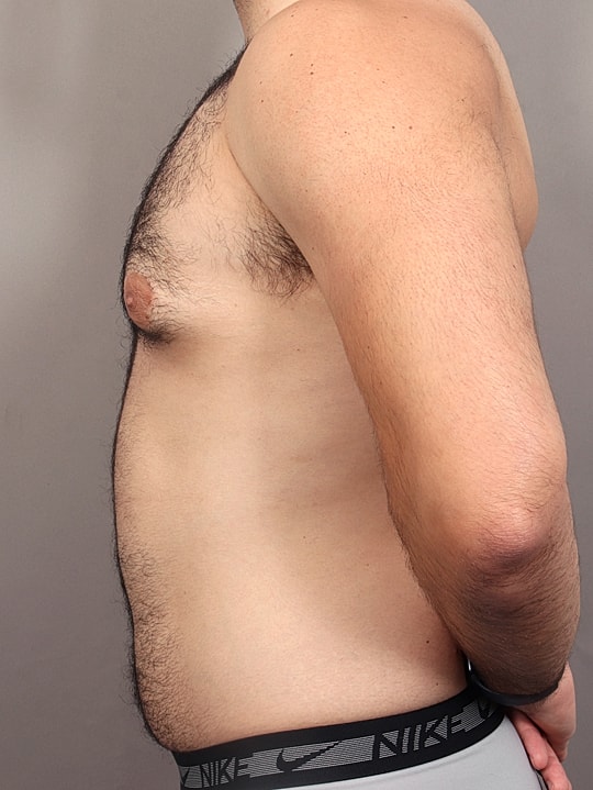 Gynecomastia Before & After