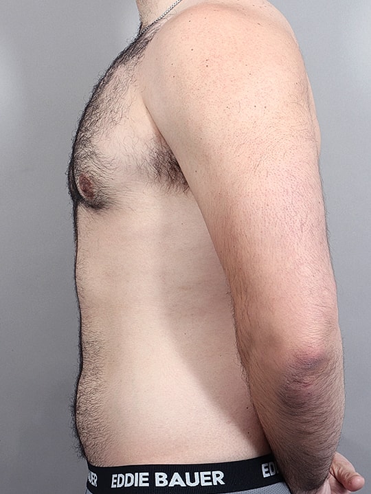 Gynecomastia Before & After