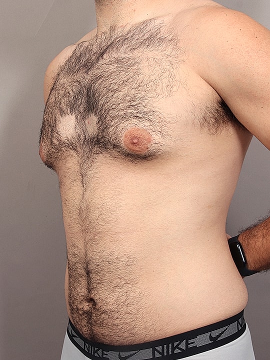 Gynecomastia Before & After