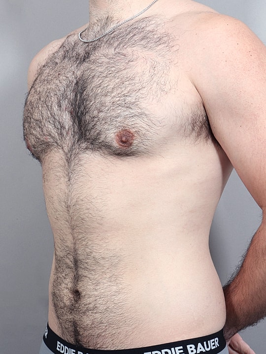 Gynecomastia Before & After