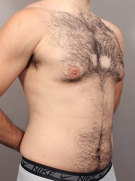 Gynecomastia Before & After