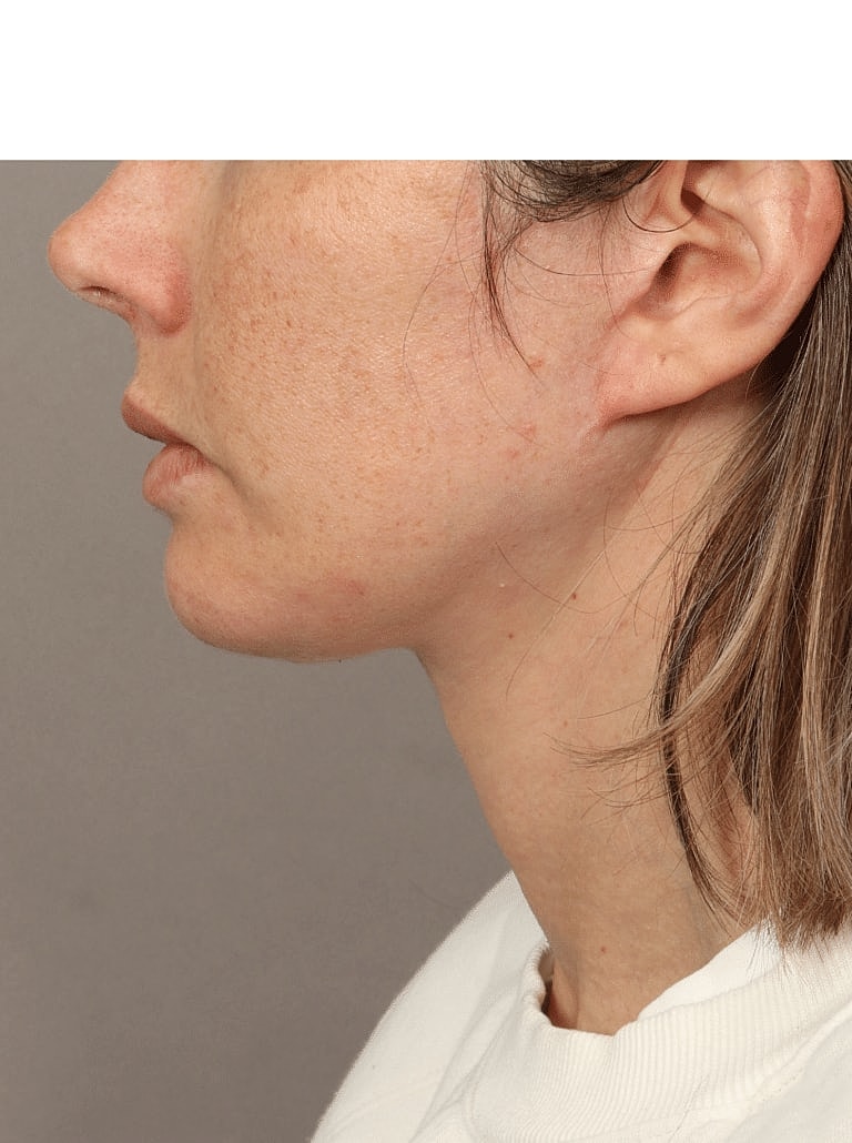 Buccal Fat Removal Before & After