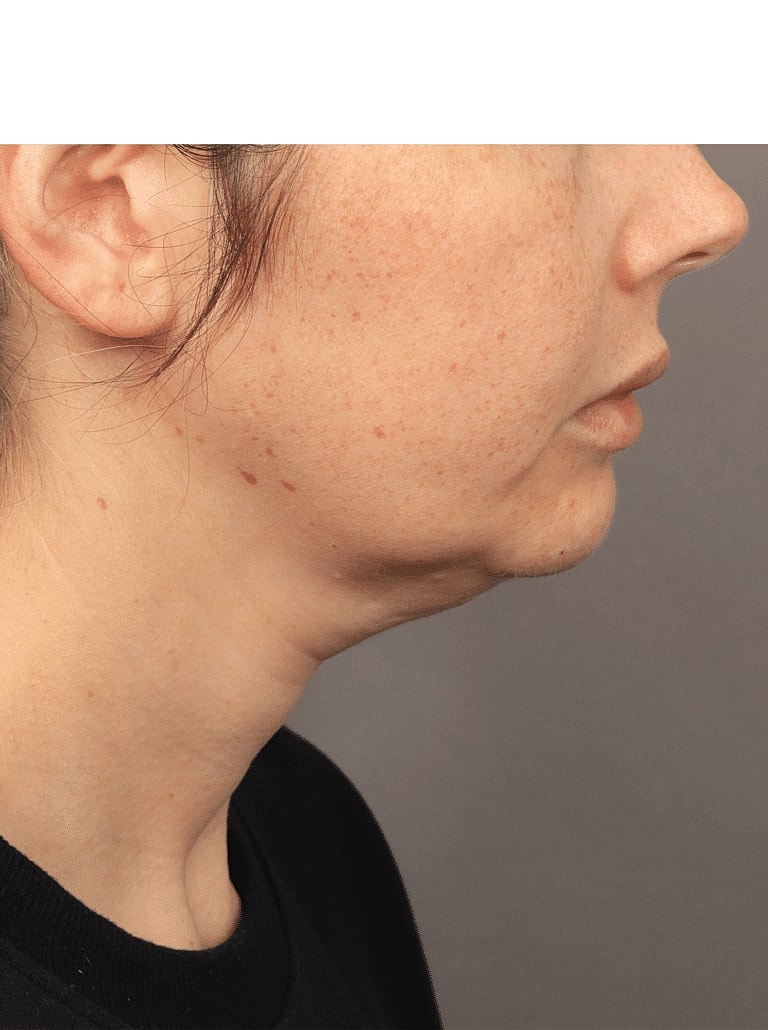 Buccal Fat Removal Before & After