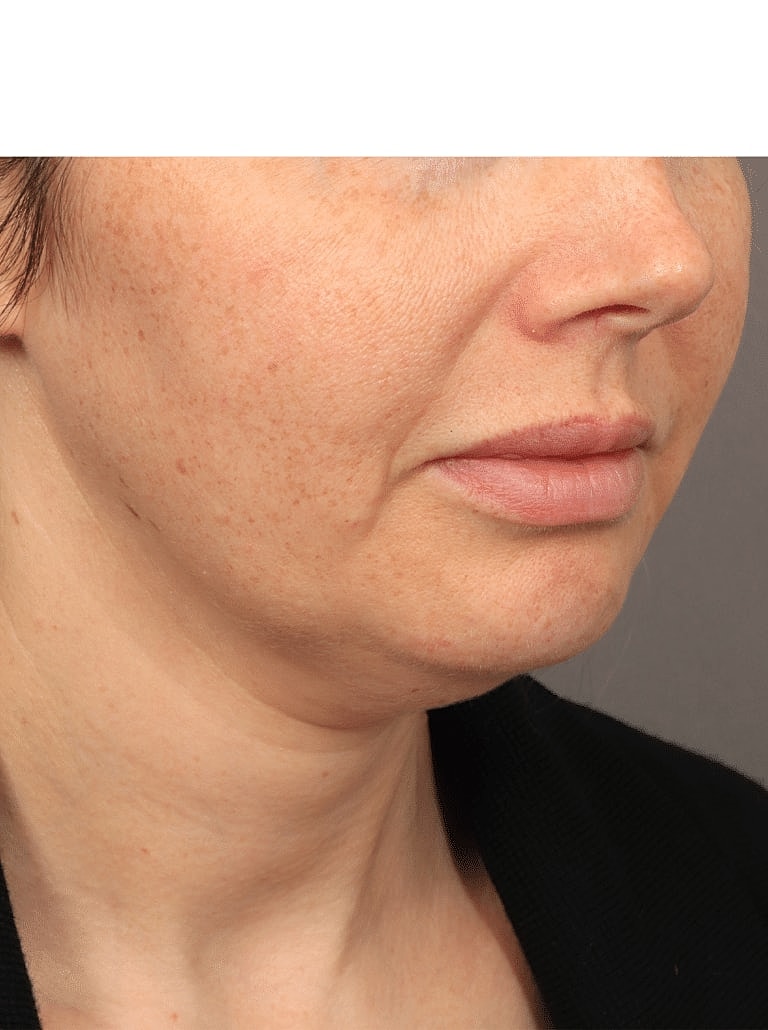 Buccal Fat Removal Before & After