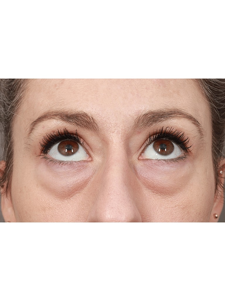 Buccal Fat Removal Before & After