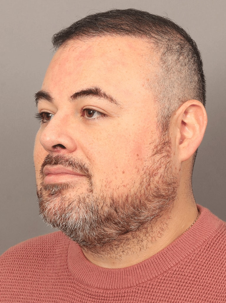 Buccal Fat Removal Before & After