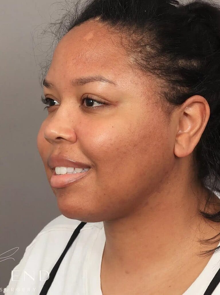 Buccal Fat Removal Before & After