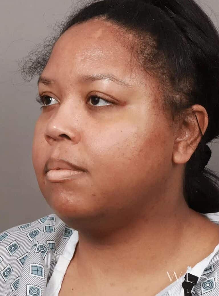 Buccal Fat Removal Before & After