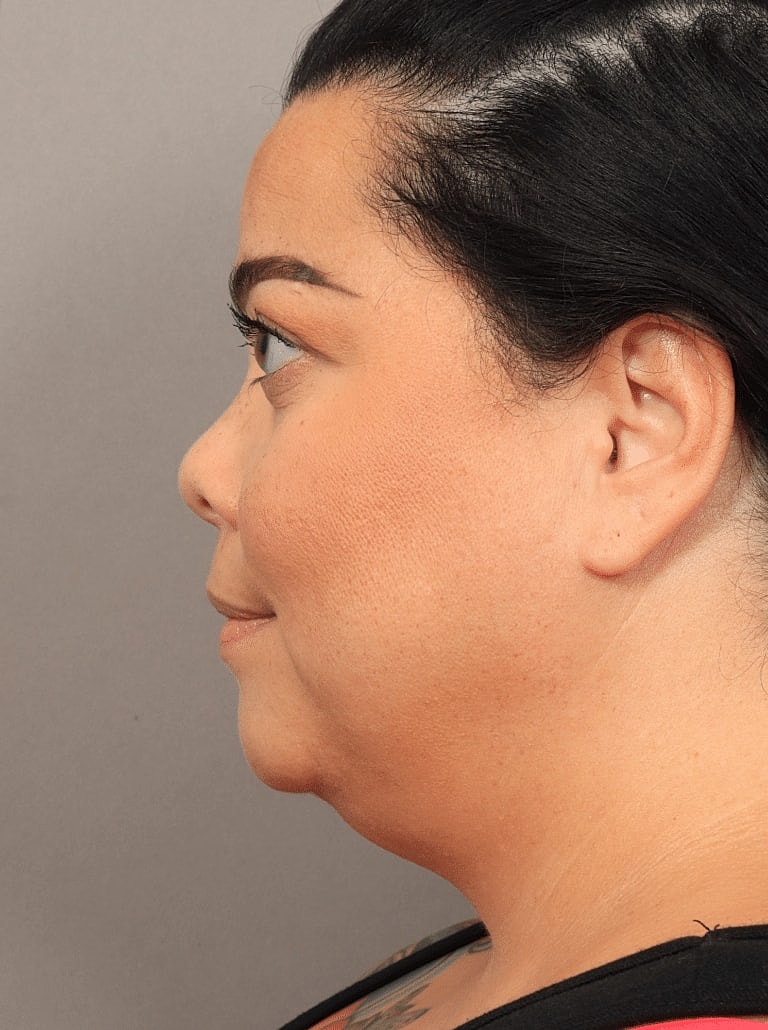 Buccal Fat Removal Before & After