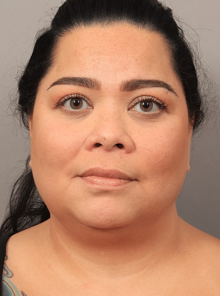 Buccal Fat Removal Before & After