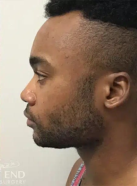 Buccal Fat Removal Before & After
