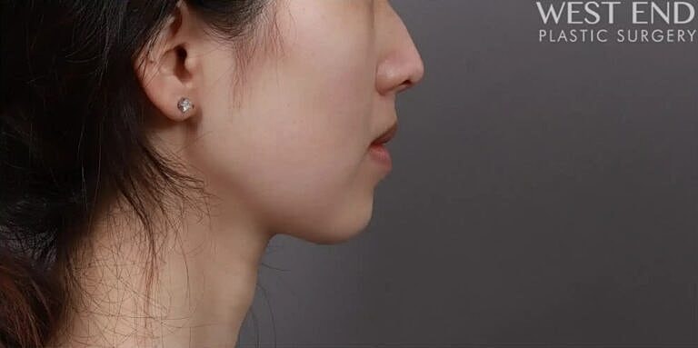 Buccal Fat Removal Before & After