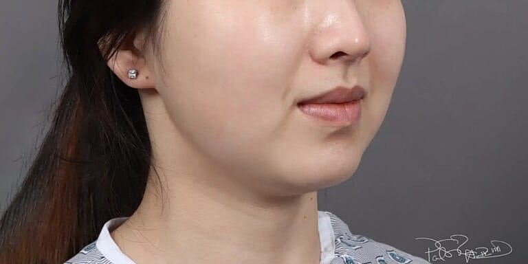 Buccal Fat Removal Before & After