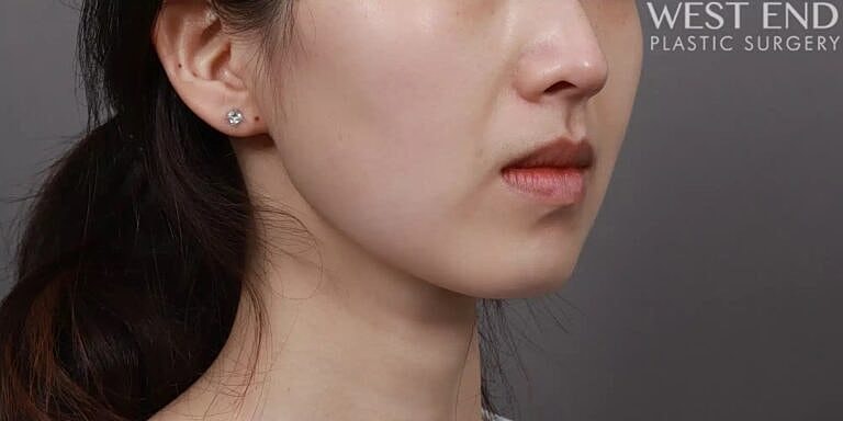 Buccal Fat Removal Before & After