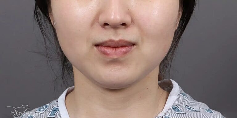 Buccal Fat Removal Before & After