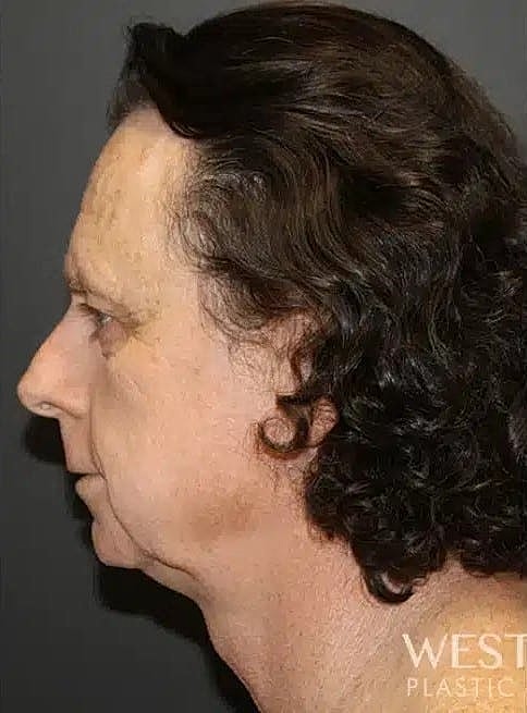 Facial Feminization Surgery Before & After