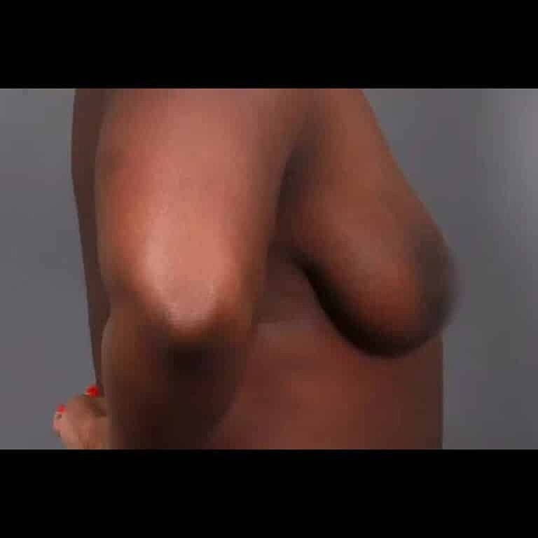 Breast Implant Exchange Before & After