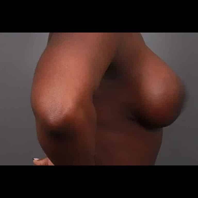 Breast Implant Exchange Before & After