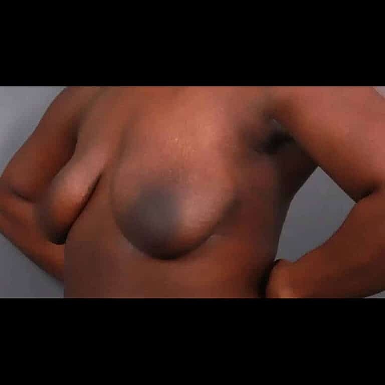 Breast Implant Exchange Before & After