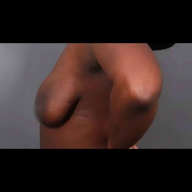 Breast Implant Exchange Before & After